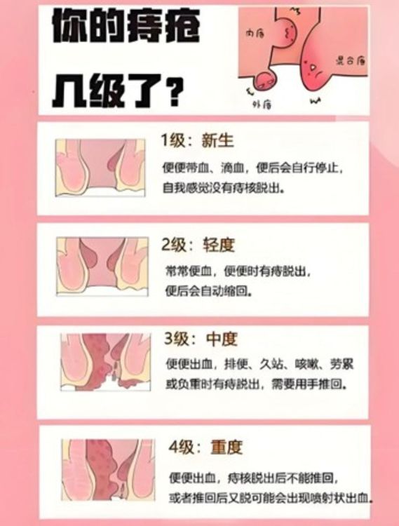 痔疮产生的原因,怎样预防和治疗?