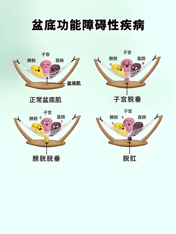 什么是女性盆底功能障碍性疾病?